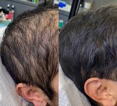 Procell Microchanneling for Hair Growth